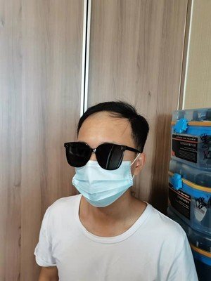 补发前,发际线超高 补发前,发际线超高