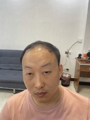 补发前额头高