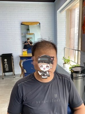 补发前头顶稀疏