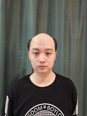 补发前：秃顶