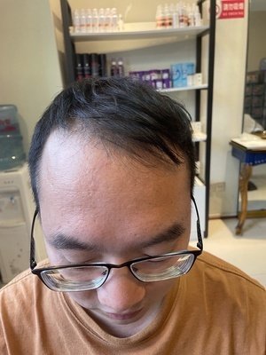 补发前头发稀少，发际线高