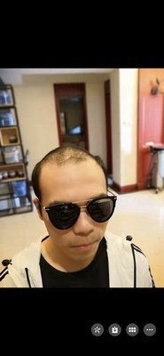 补发前发际线高 补发前发际线高