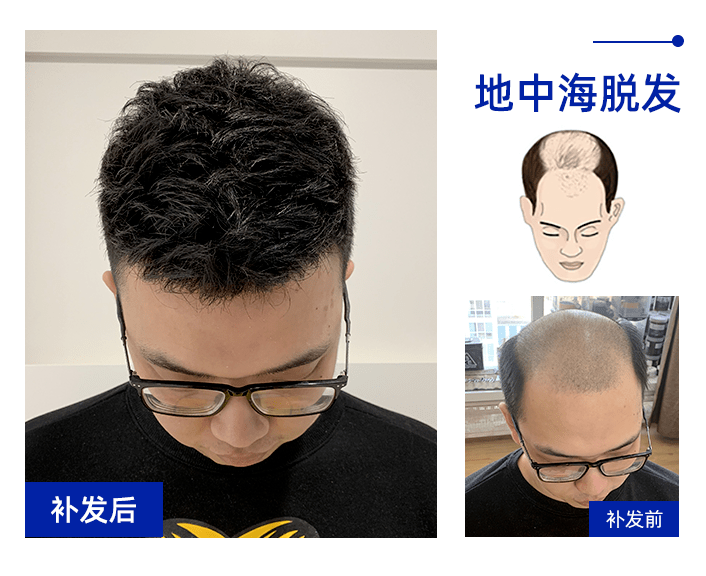 地中海脱发补发效果