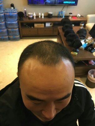 补发前M型发际线高 补发前M型发际线高