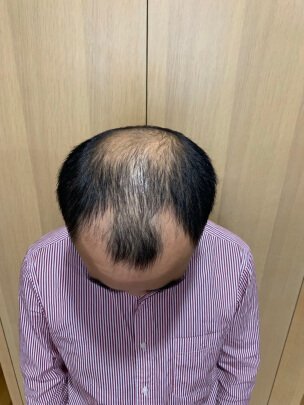 补发前头发稀疏，M型，秃顶