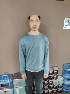 补发前秃顶效果 补发前秃顶效果
