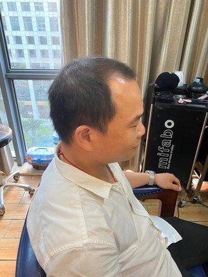 补发前M型脱发 补发前M型脱发
