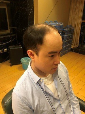 补发前秃顶效果 补发前秃顶效果