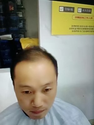 补发前发际线高、秃顶 补发前发际线高、秃顶