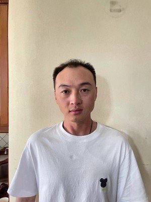 补发前M型脱发 补发前M型脱发
