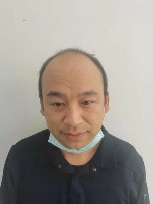 补发前秃顶苍老 补发前秃顶苍老