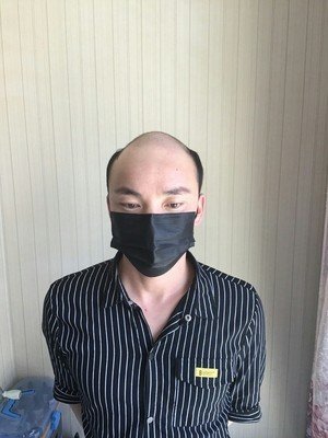 补发前地中海秃顶 补发前地中海秃顶