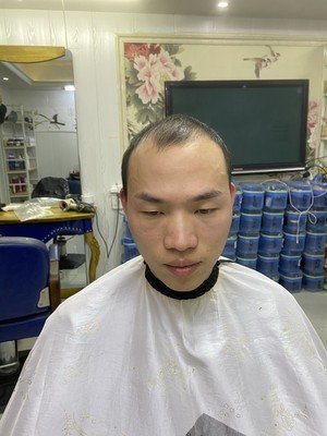 补发前M型脱发 补发前M型脱发
