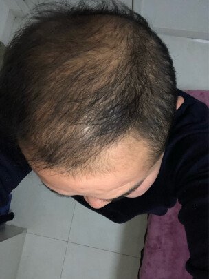 补发前头发稀疏 补发前头发稀疏