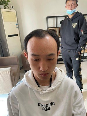 补发前M型脱发 补发前M型脱发