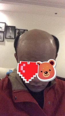 补发前秃顶效果 补发前秃顶效果