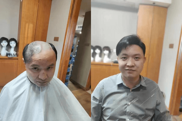 秃顶补发案例 秃顶补发案例