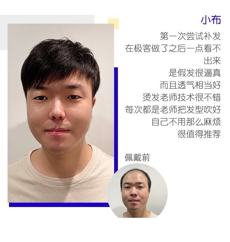 小布头发稀少补发效果 小布头发稀少补发效果