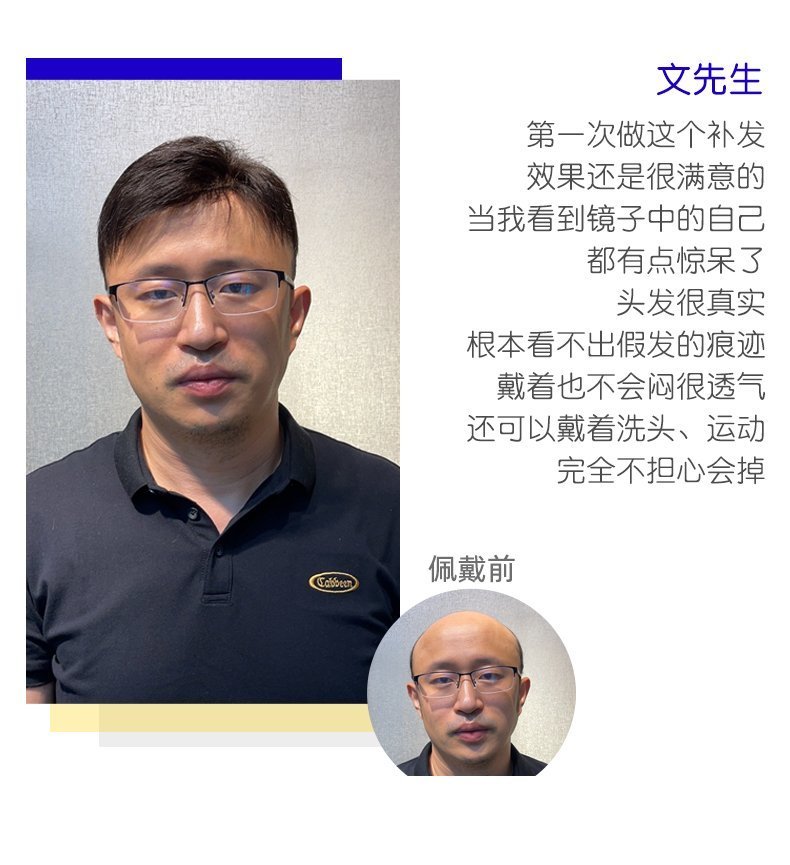 文先生秃顶补发效果展示 文先生秃顶补发效果展示