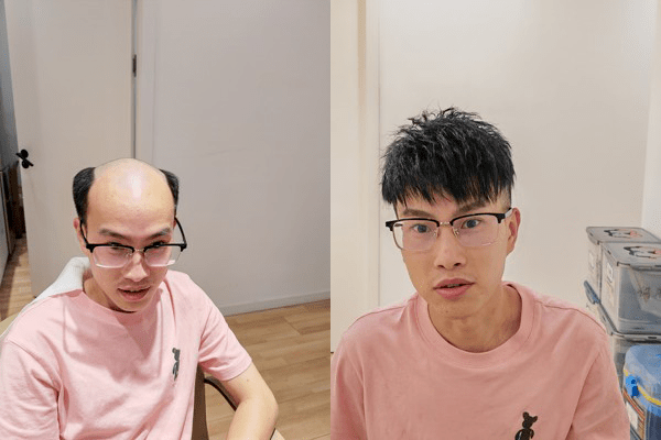 头顶稀少佩戴假发片效果 头顶稀少佩戴假发片效果