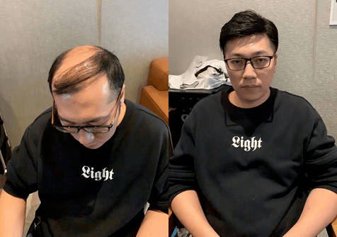 男士假发片头顶补发片戴的人多吗？