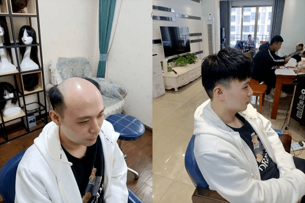 男生秃头戴假发好吗？