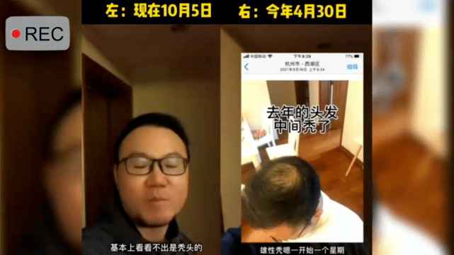男子不用洗发水秃顶变黑发是真的吗？