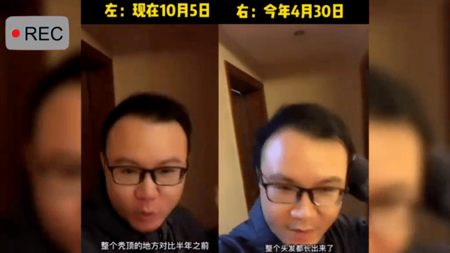 男子坚持半年清水洗头，从秃顶变满头黑发