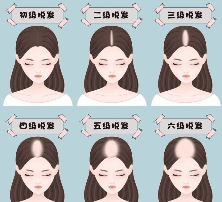 女士脱发1-7级程度图片 女士脱发1-7级程度图片