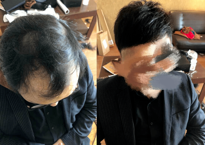 m型掉头发是遗传的吗？