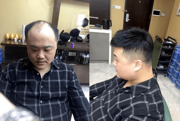 戴上效果头顶看不出来是假发 戴上效果头顶看不出来是假发