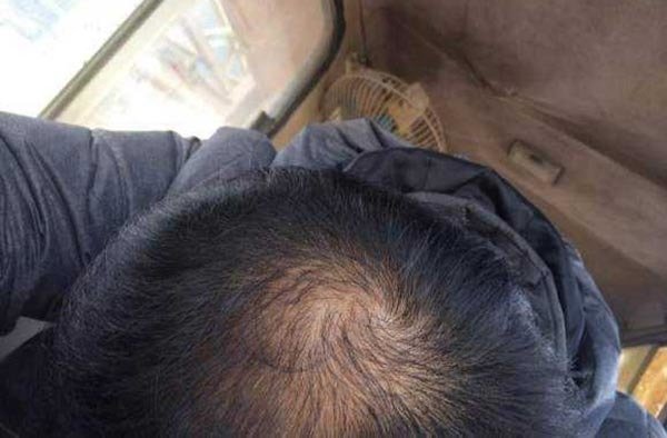 头顶脱发越来越稀疏怎么办？