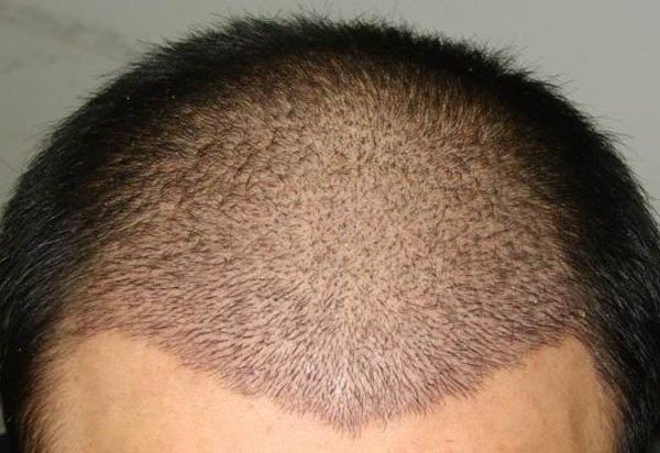 植发后三年内掉光了，是什么样原因？怎么办？