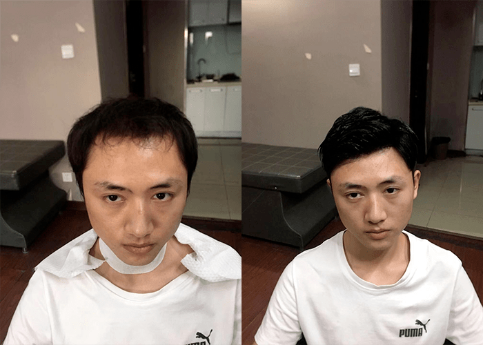 为什么高发际线遗传性那么高？