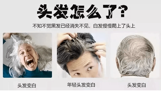 男人脱发白发是肾虚吗