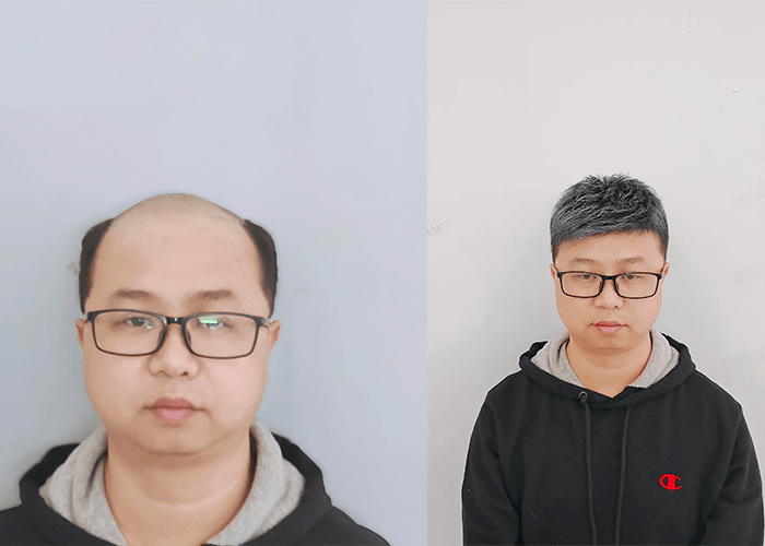 脱发的用户佩戴效果很赞,也自己做一个非常满意 脱发的用户佩戴效果很赞,也自己做一个非常满意