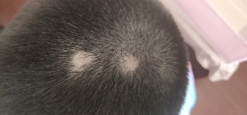 斑秃用什么药最好？