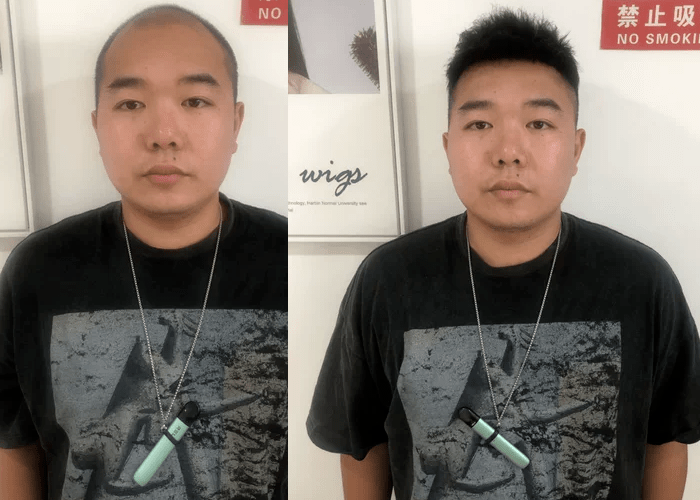 秃头补发效果 秃头补发效果
