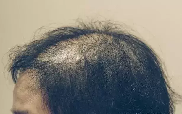 保护头发毛囊 保护头发毛囊
