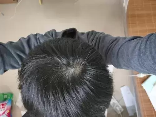 头顶漩涡处头发少是秃顶吗? 头顶漩涡处头发少是秃顶吗?