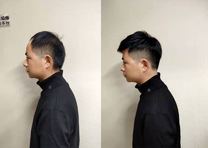 脱发戴假发比戴帽更合适