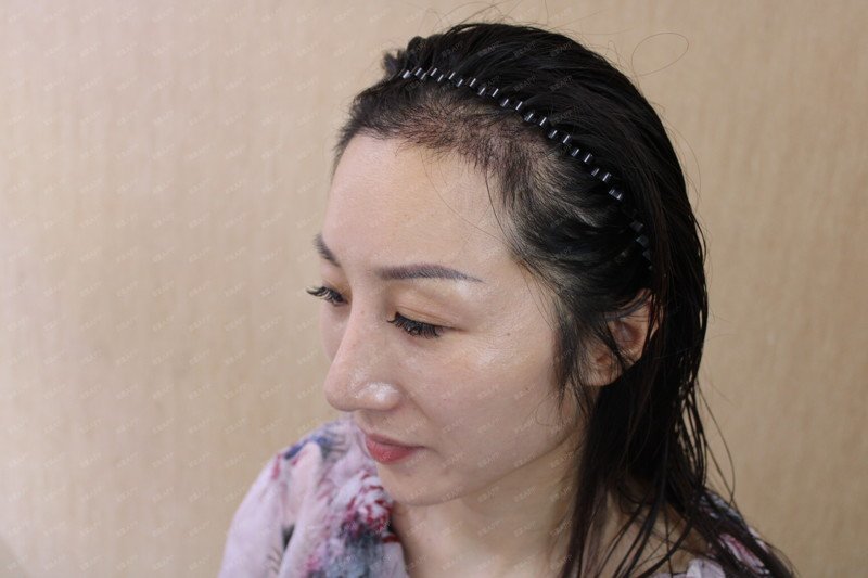 什么情况不适合植发