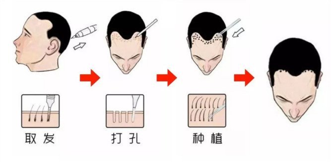 头发移植
