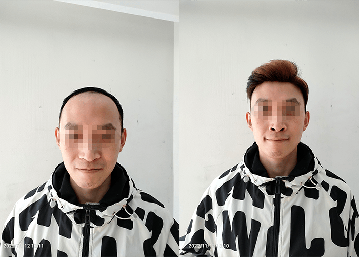 假发补发效果 假发补发效果