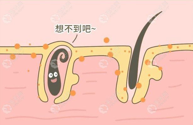 植发和假发哪个好 植发和假发哪个好