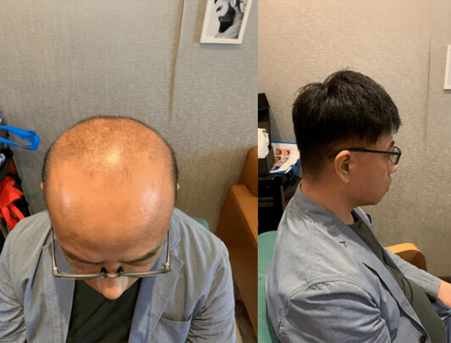 做出来的假发戴上非常的合适,贴合性特别好,就像是自己的头发一样 做出来的假发戴上非常的合适,贴合性特别好,就像是自己的头发一样
