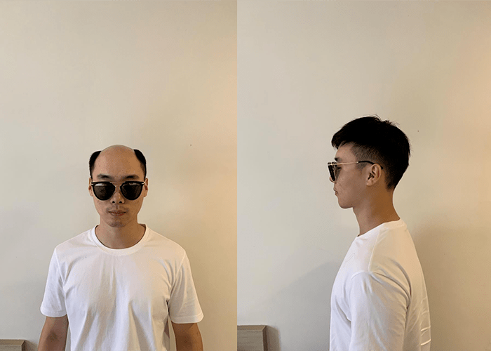 男生头顶头发稀少可以用假发吗？