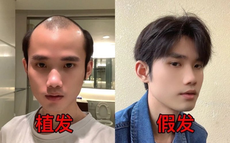植发VS假发