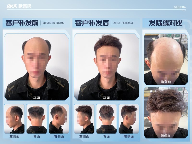 自然融合发际线 自然融合发际线