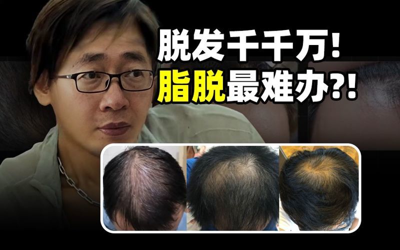 防脱发方法有哪些？